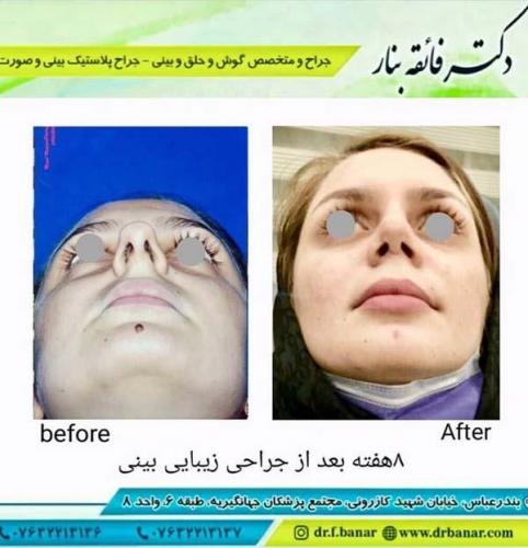 جراحی بینی در بندرعباس 165
