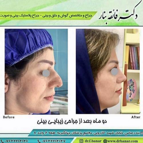 جراحی بینی در بندرعباس 166