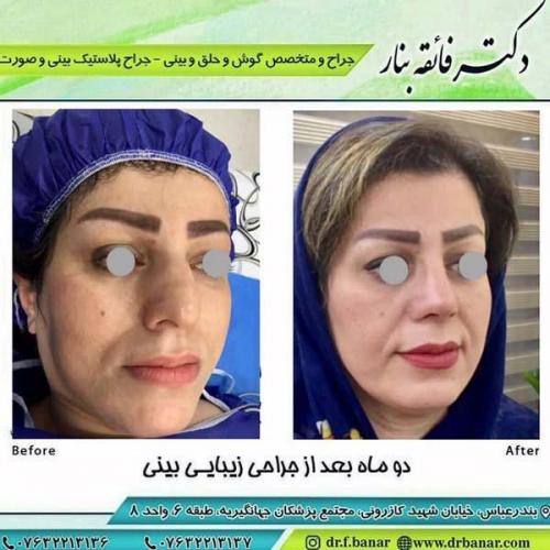 جراحی بینی در بندرعباس 167