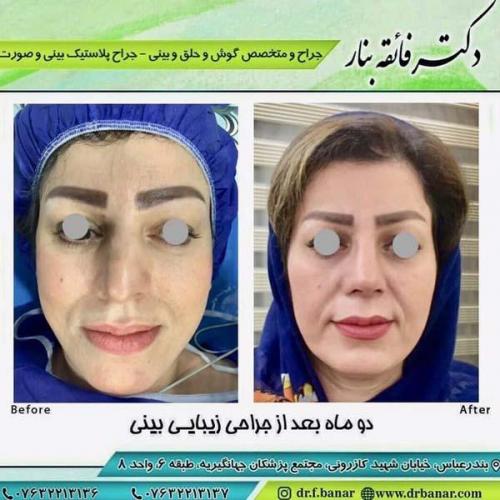 جراحی بینی در بندرعباس 168