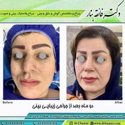 جراحی بینی در بندرعباس 169