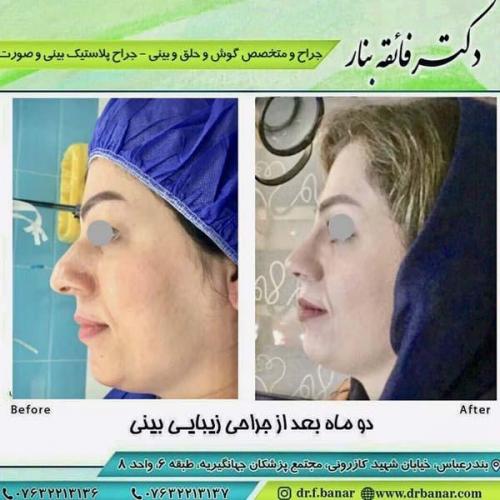جراحی بینی در بندرعباس 170