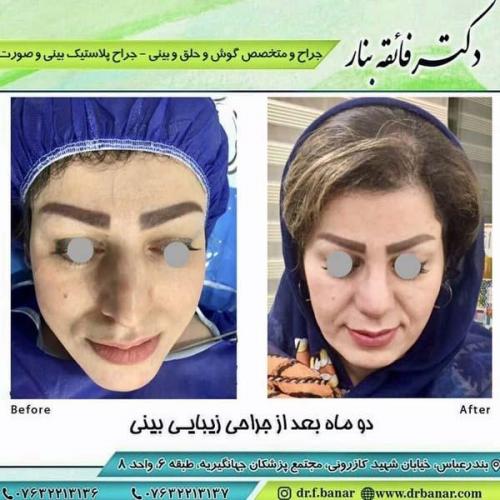 جراحی بینی در بندرعباس 171