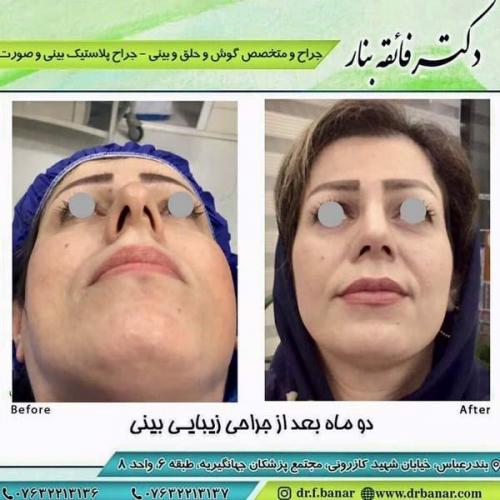 جراحی بینی در بندرعباس 172