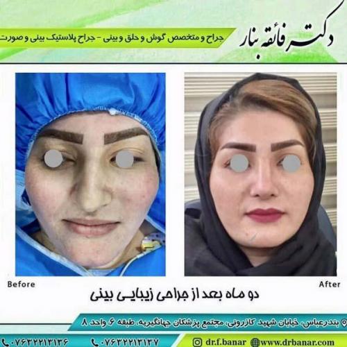 جراحی بینی در بندرعباس 173