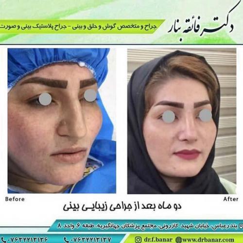 جراحی بینی در بندرعباس 174