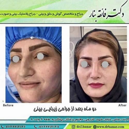 جراحی بینی در بندرعباس 175