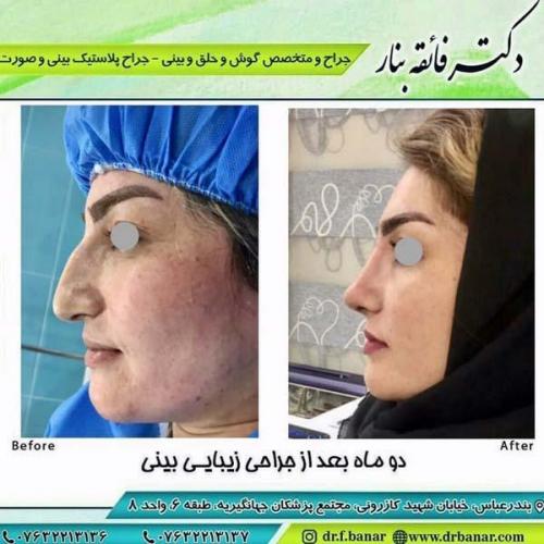 جراحی بینی در بندرعباس 176