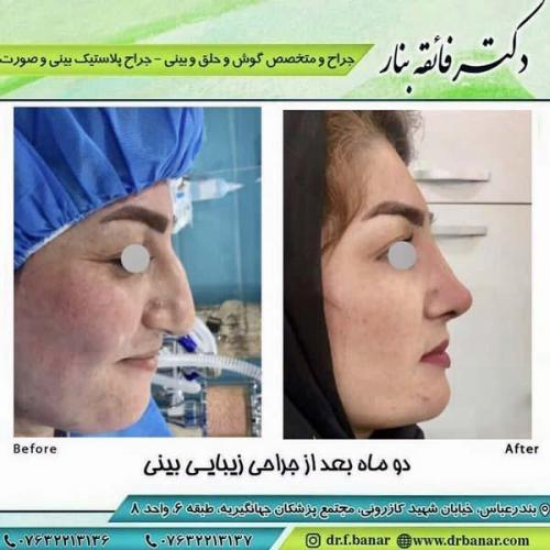 جراحی بینی در بندرعباس 177