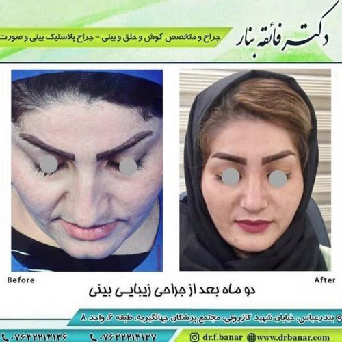جراحی بینی در بندرعباس 178