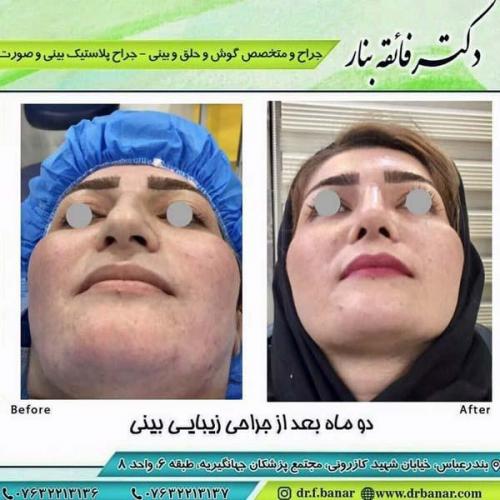 جراحی بینی در بندرعباس 179