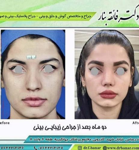 جراحی بینی در بندرعباس 180