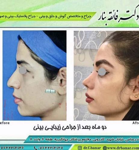 جراحی بینی در بندرعباس 181