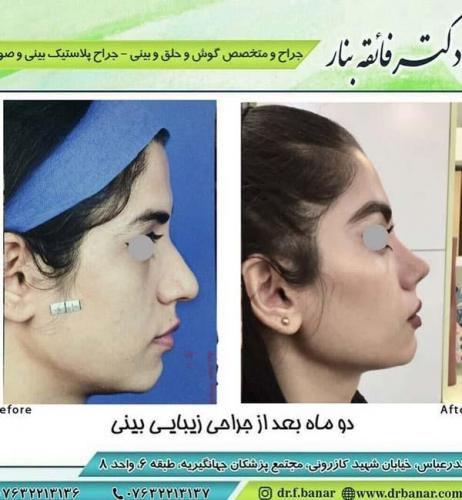 جراحی بینی در بندرعباس 182