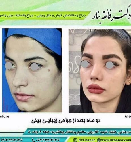 جراحی بینی در بندرعباس 183