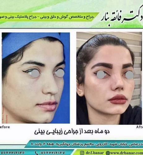 جراحی بینی در بندرعباس 184