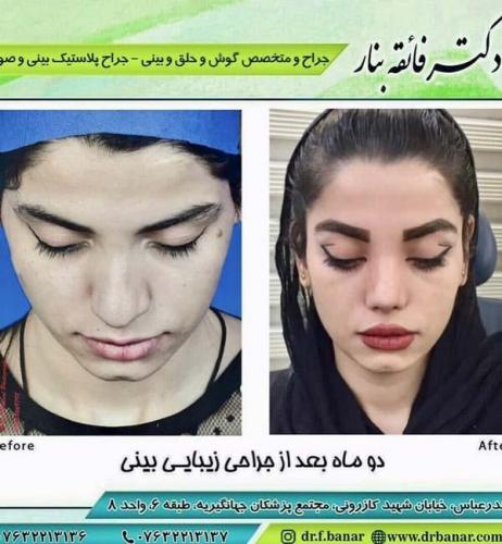 جراحی بینی در بندرعباس 185