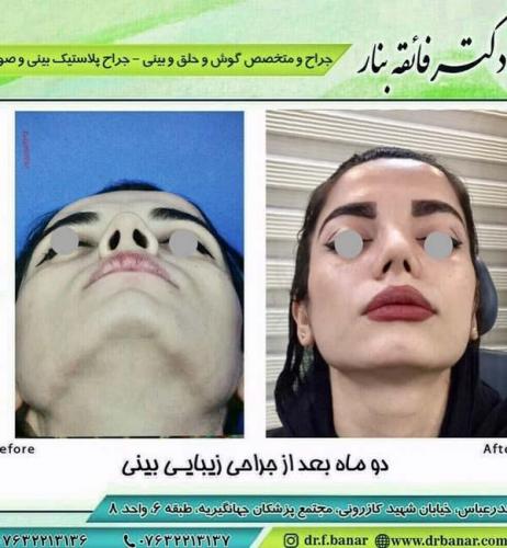 جراحی بینی در بندرعباس 186