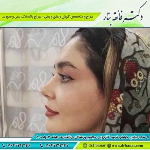 جراحی بینی در بندرعباس 190
