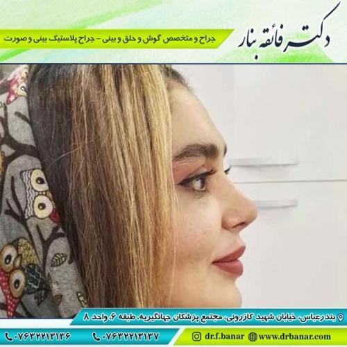 جراحی بینی در بندرعباس 191