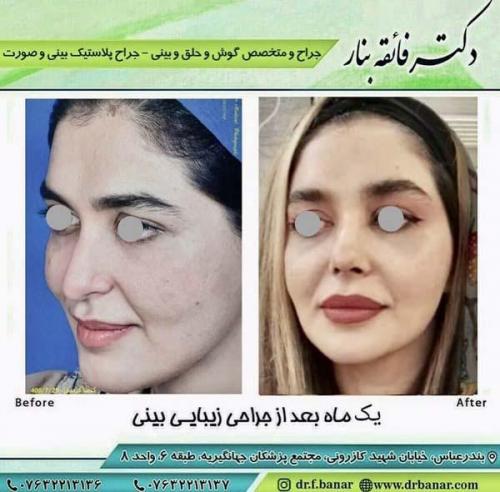 جراحی بینی در بندرعباس 192