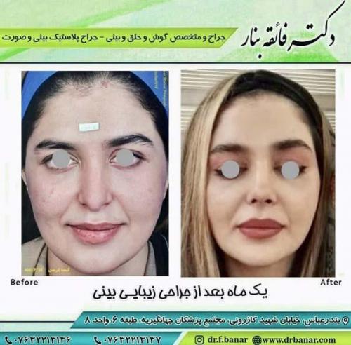 جراحی بینی در بندرعباس 193