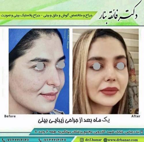 جراحی بینی در بندرعباس 194