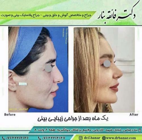جراحی بینی در بندرعباس 195