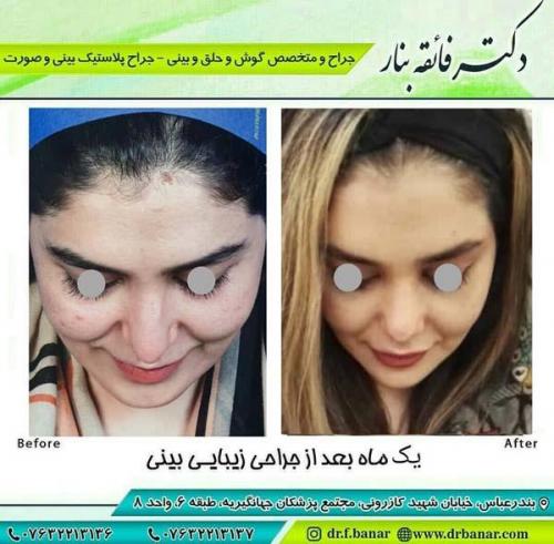 جراحی بینی در بندرعباس 196
