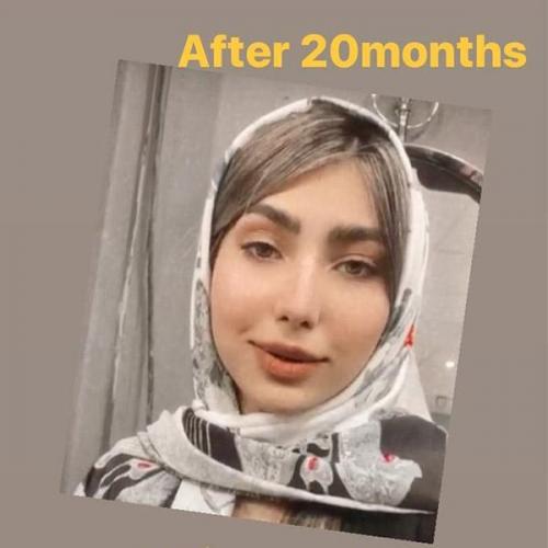 جراحی بینی در بندرعباس 200