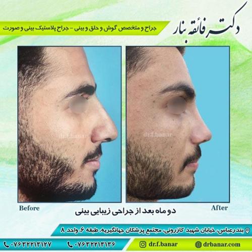 جراحی زیبایی بینی 1