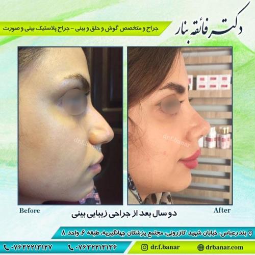 جراحی زیبایی بینی 10