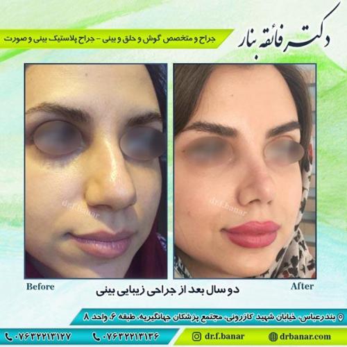 جراحی زیبایی بینی 11