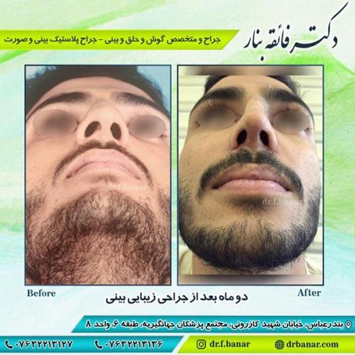 جراحی زیبایی بینی 2