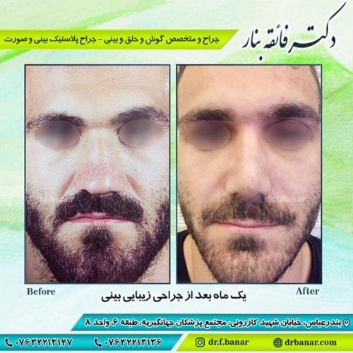 جراحی زیبایی بینی 3