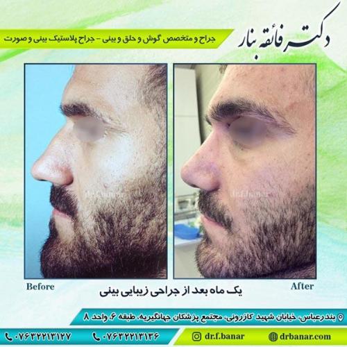 جراحی زیبایی بینی 4