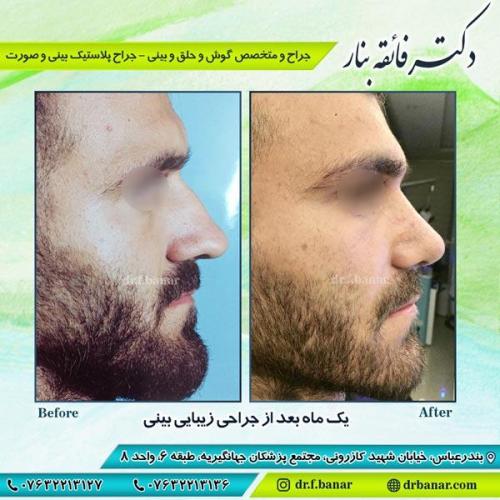 جراحی زیبایی بینی 5