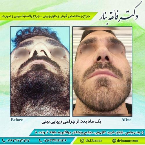 جراحی زیبایی بینی 6