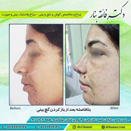 جراحی زیبایی بینی 8