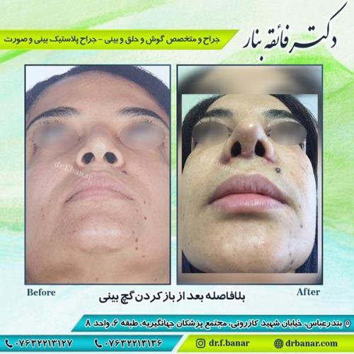 جراحی زیبایی بینی 9