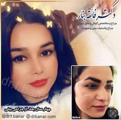 جراحی-بینی-در-بندرعباس-233