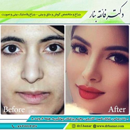 جراحی-بینی-در-بندرعباس-234