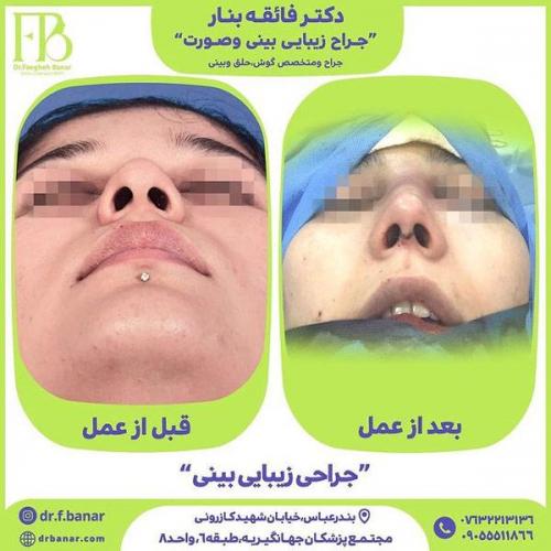 جراحی-بینی-در-بندرعباس-235