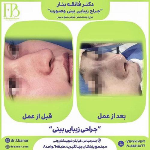 جراحی-بینی-در-بندرعباس-236