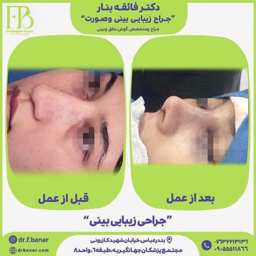 جراحی-بینی-در-بندرعباس-237