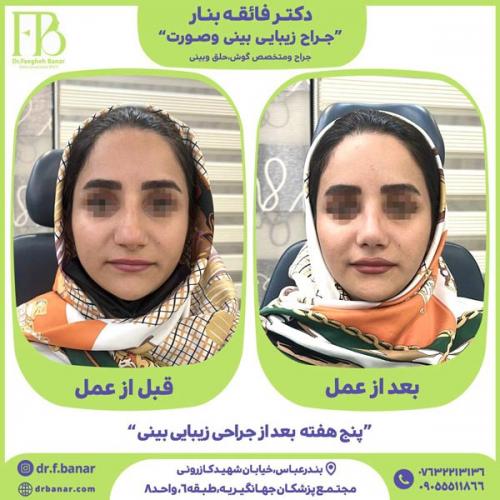 جراحی-بینی-در-بندرعباس-238