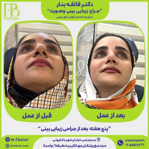 جراحی-بینی-در-بندرعباس-239