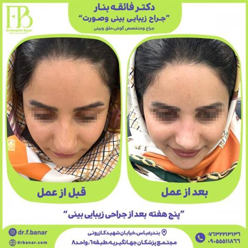 جراحی-بینی-در-بندرعباس-240