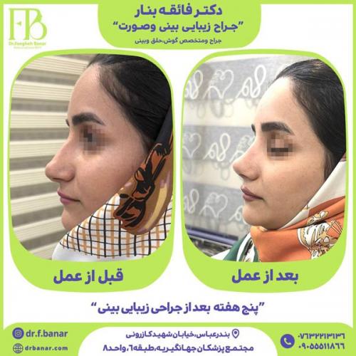 جراحی-بینی-در-بندرعباس-241