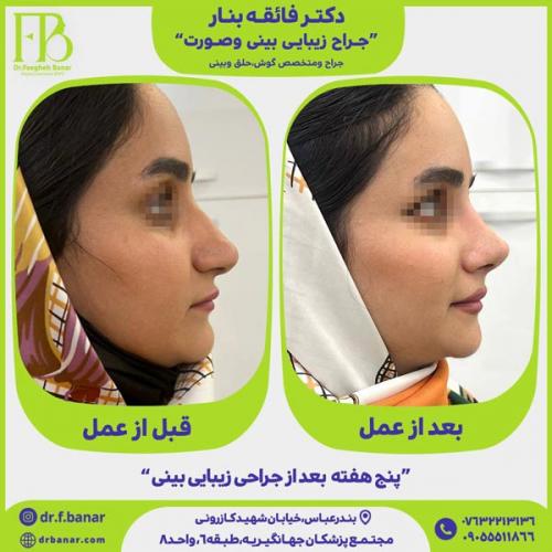 جراحی-بینی-در-بندرعباس-242